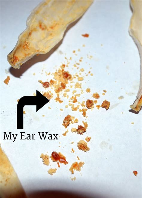 ear candle results|ear candling does it work.